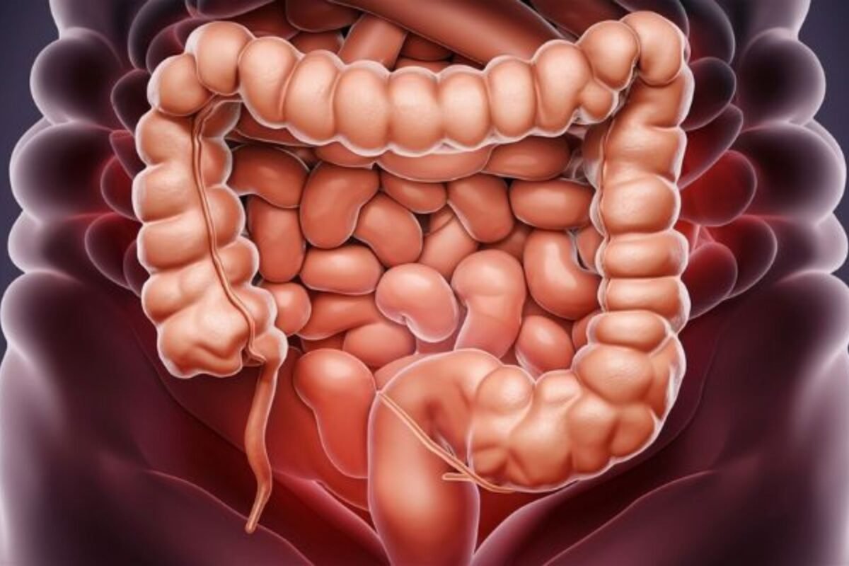 Cáncer de apéndice: nuevos datos revelaron un aumento de casos en adultos jóvenes
