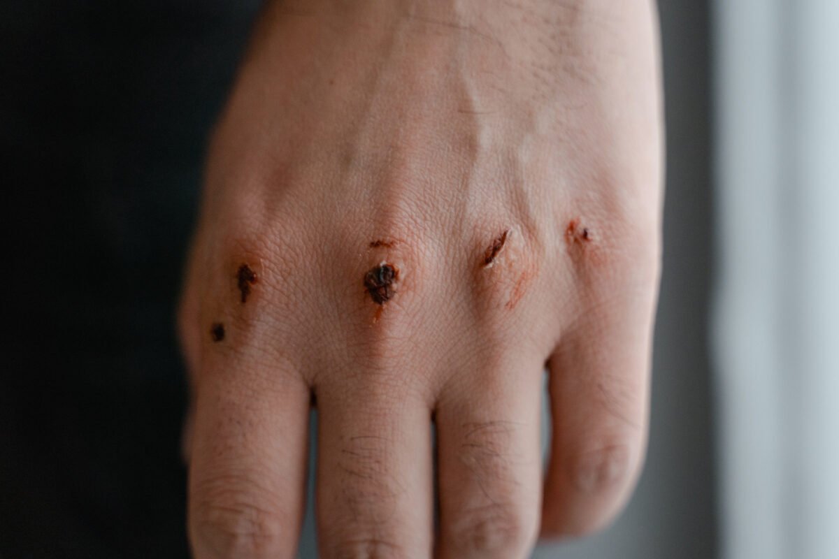Zigomicosis: cuáles son los síntomas y tratamiento de la infección por hongos